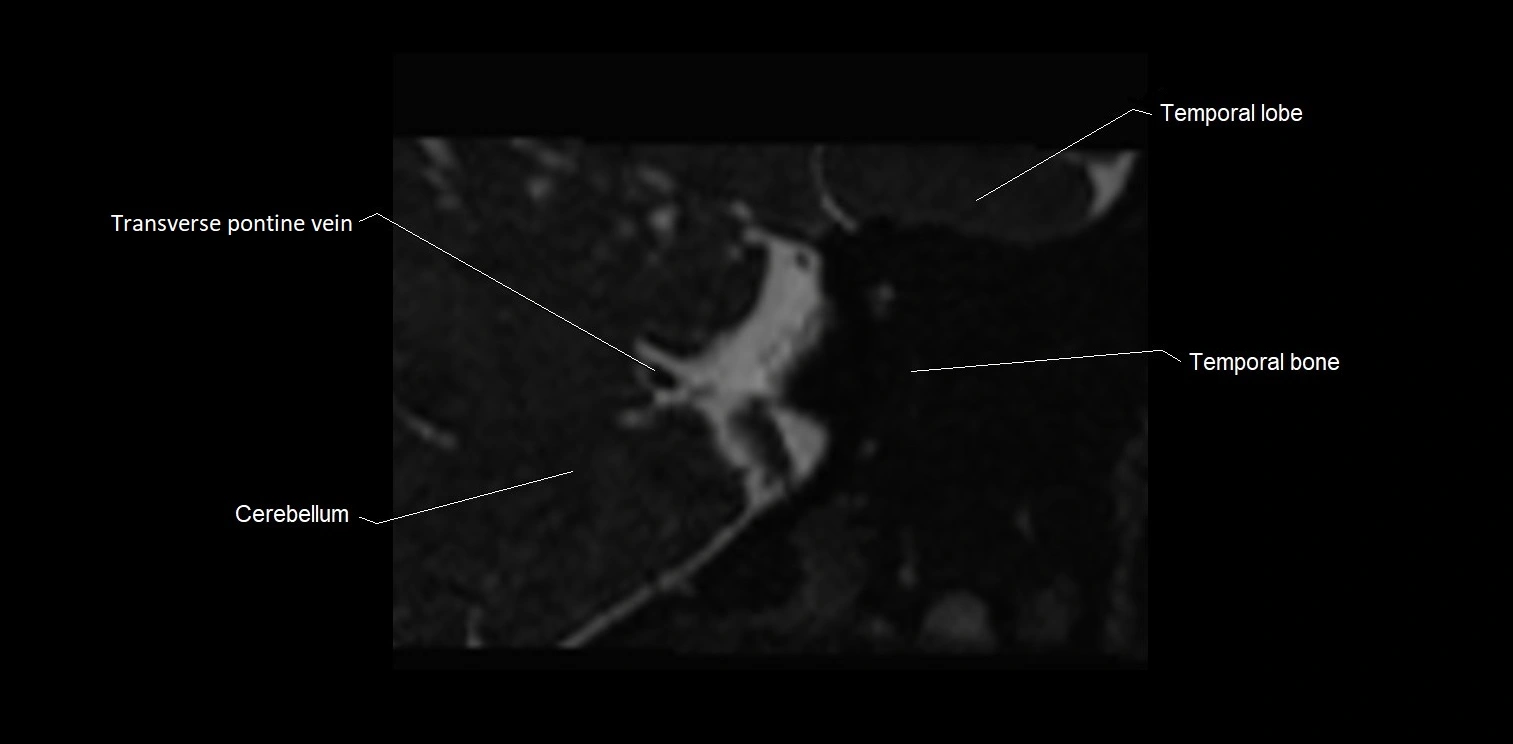 MRI Internal auditory meatus (IAM) coronal cross sectional labelled anatomy image 36.webp
